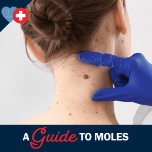 A Guide to Moles: What’s Normal and When to See a Doctor