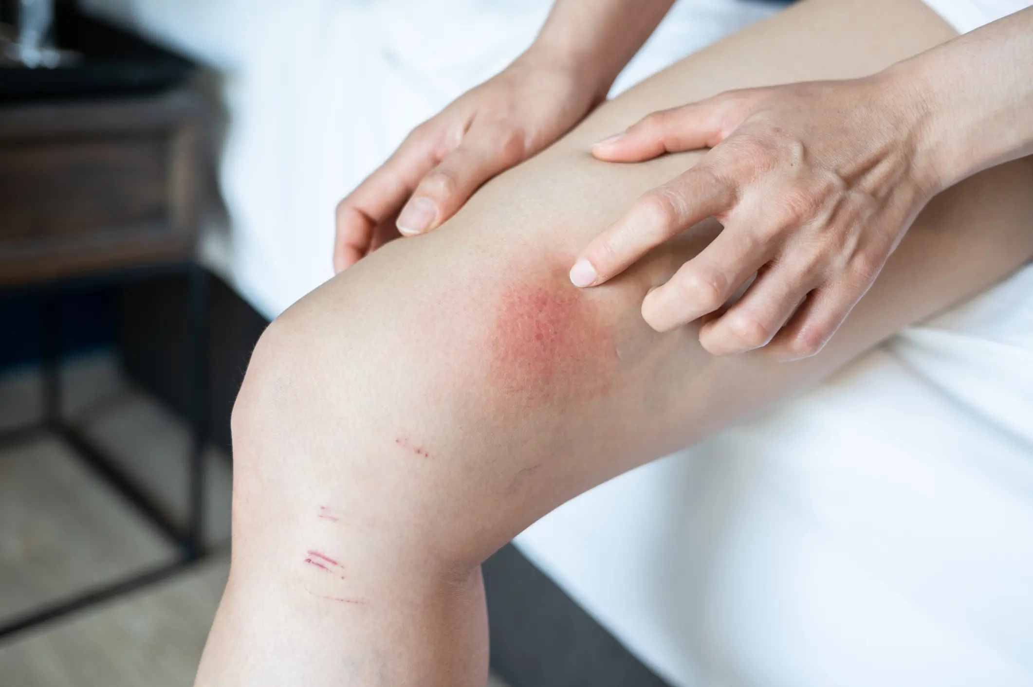 Close up of woman having itch caused of a red rash on her thigh. Close up of woman having itch caused of a red rash on her thigh