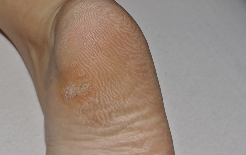 plantar-warts-wart-removal