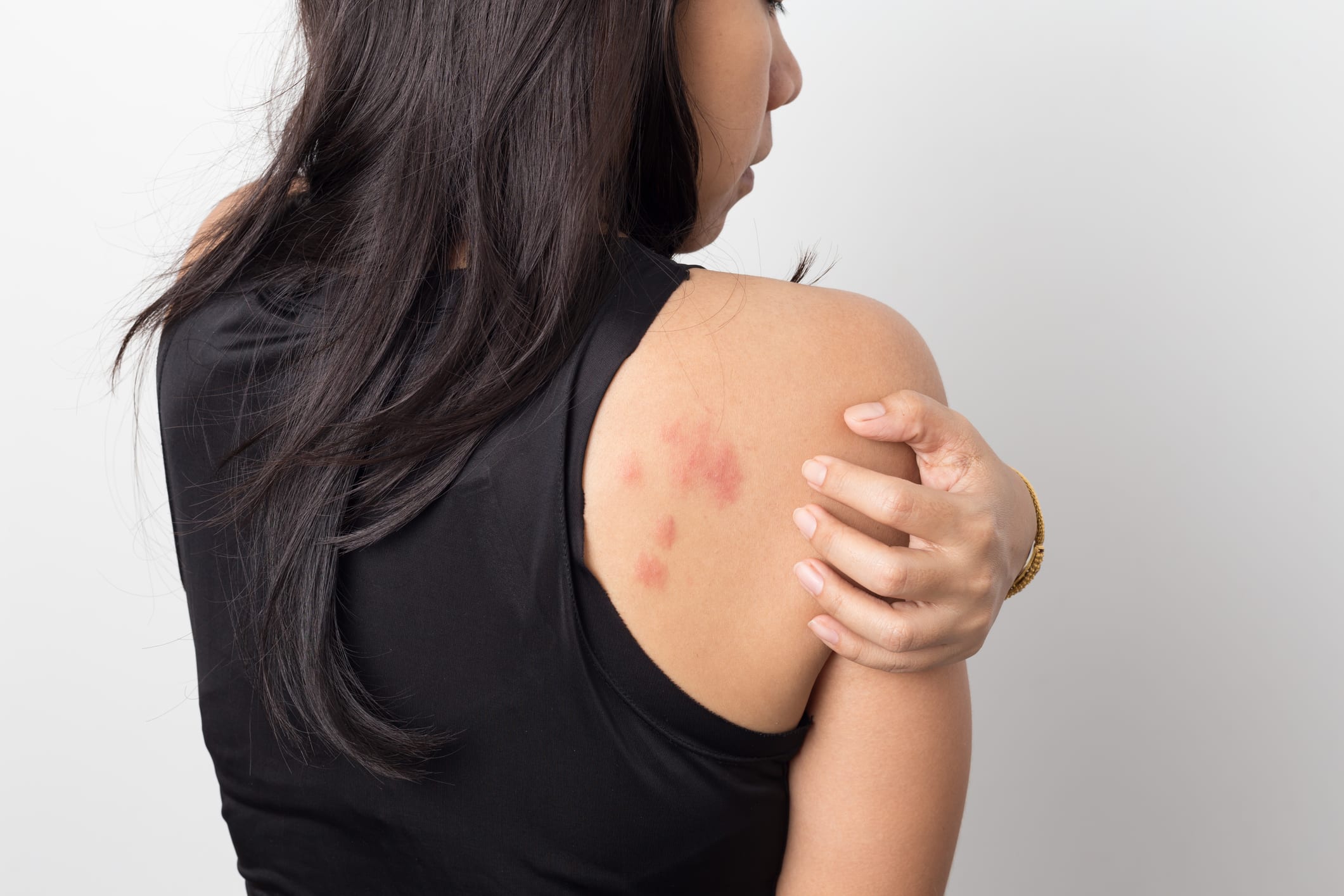 rash